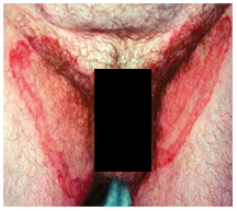 jock itch treatment cure